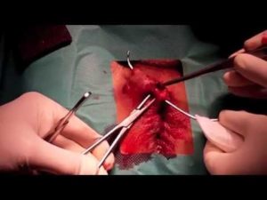 Cirurgia de fistula anal leva ponto